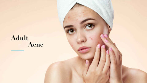 Cause of acne  Acne Natural Remedies - KarmaPlace Blog — Karmaplace