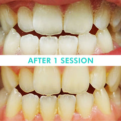 Mint Smilebar, Power Whitening Kit, LED Teeth Whitening Before and after
