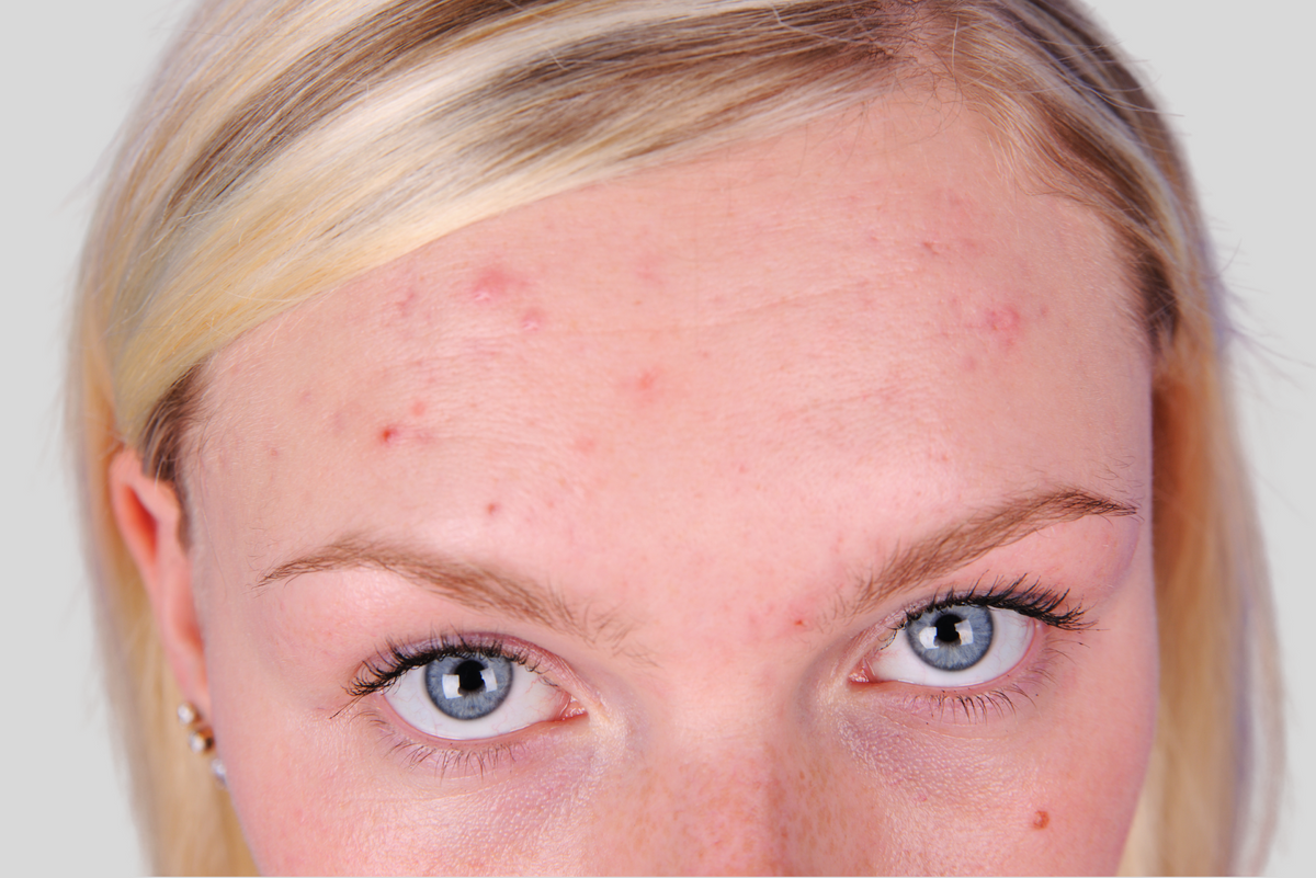 Why You Get Forehead Acne Plus How To Treat It Luminance Red