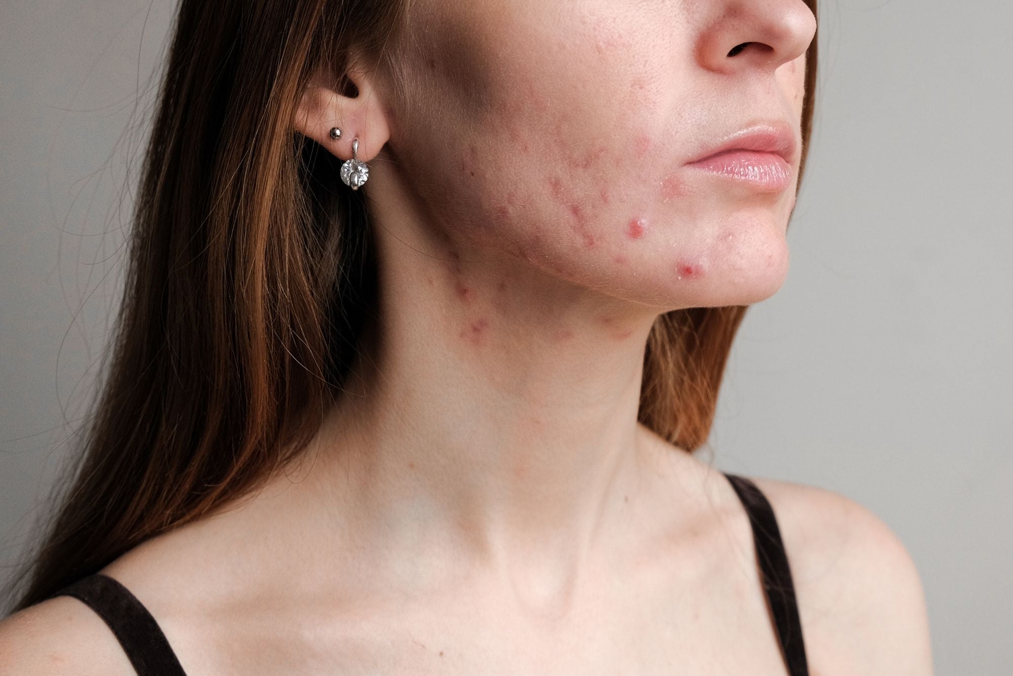 Can Nicotine Cause Acne?