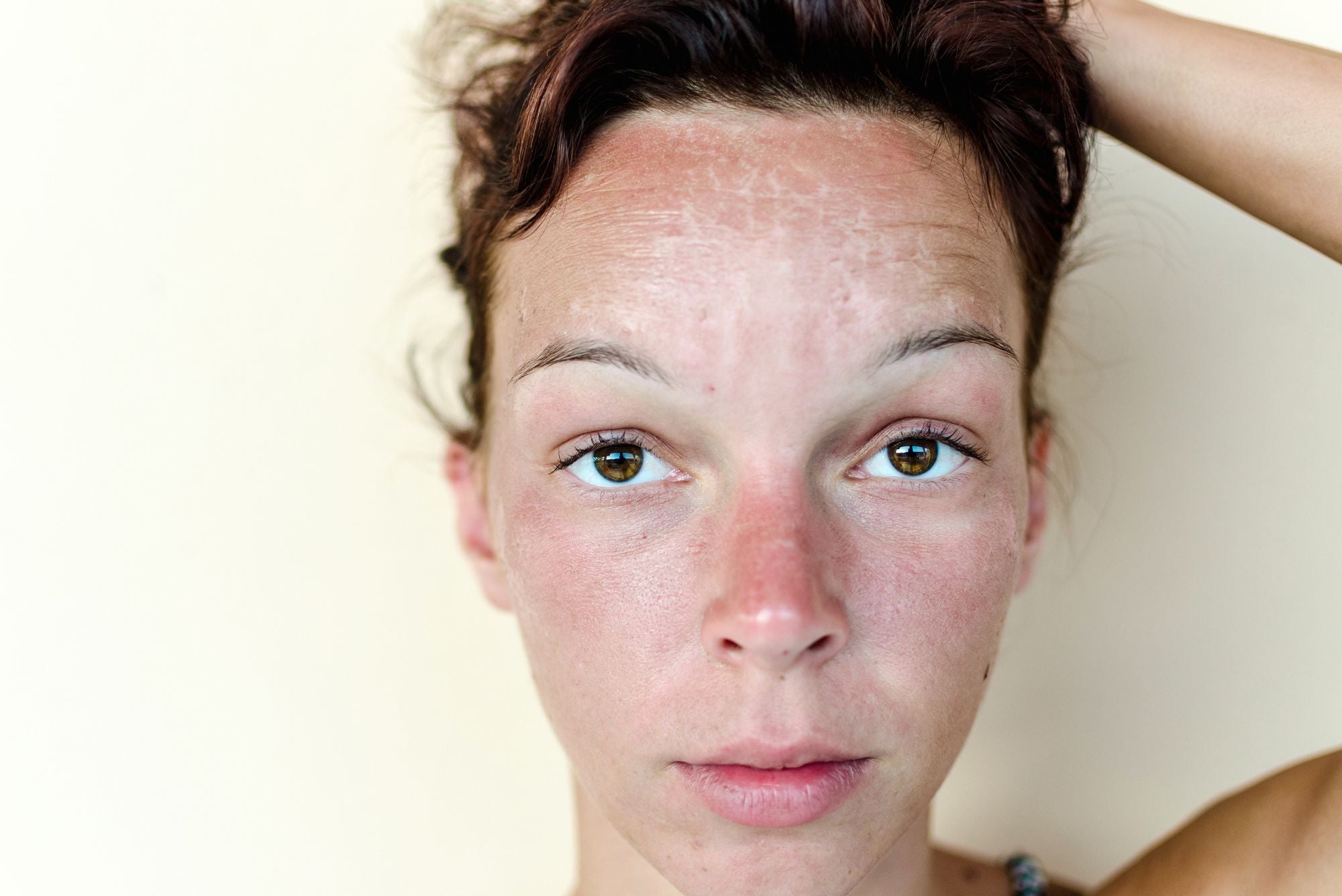 A woman with a sunburn on her face is curious if the sun helps with acne.