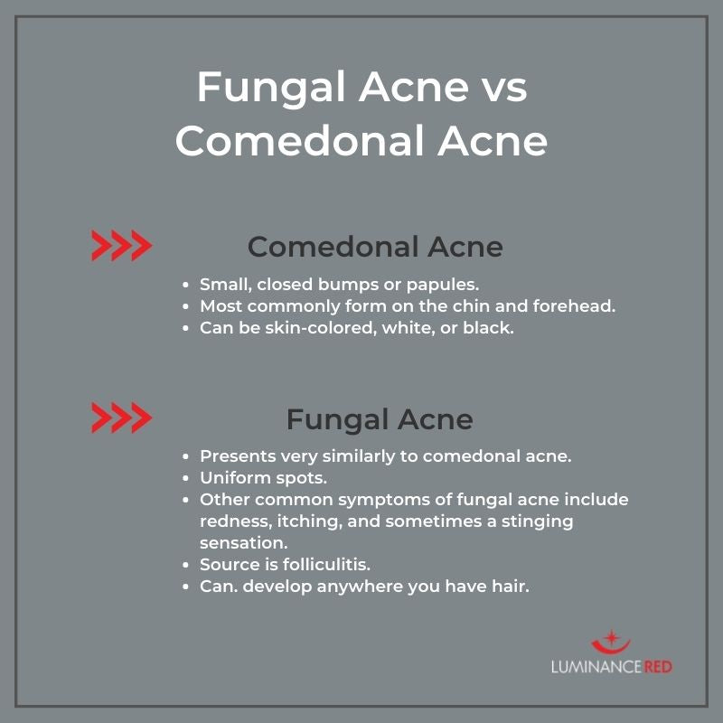Infographic: Fungal Acne vs Closed Comedones: What’s the Difference?