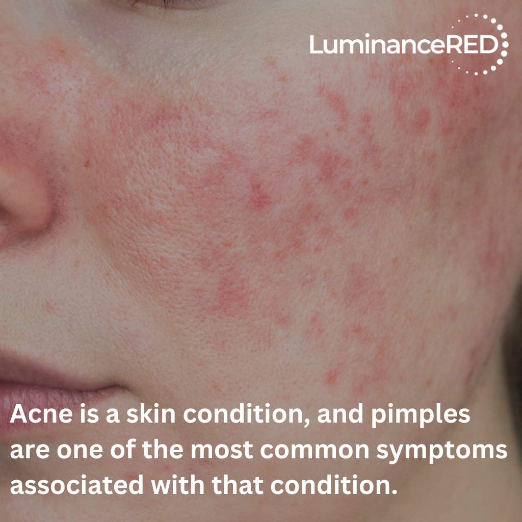 Quote: Acne vs. Pimples: How to Tell the Difference