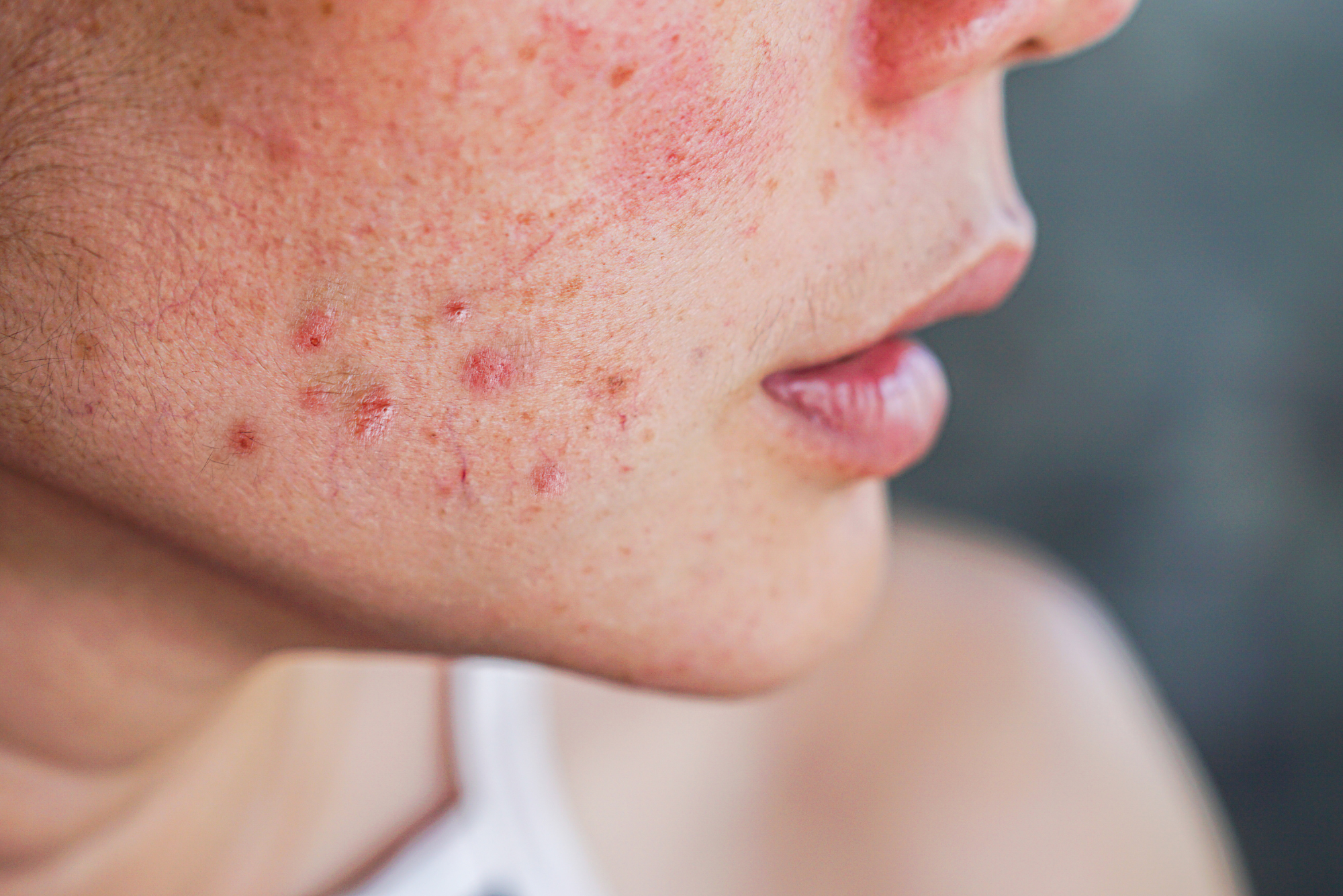 A woman suffering from acne has a breakout of pimples on her cheek, representing a discussion of acne vs. pimples.