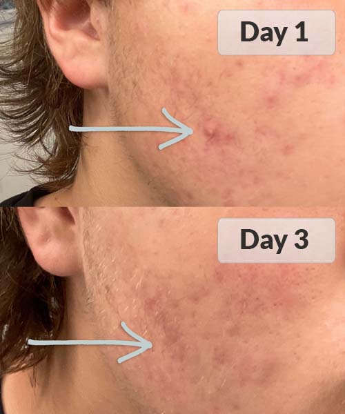 Two photos comparing the day 1 and day 3 of acne spots.