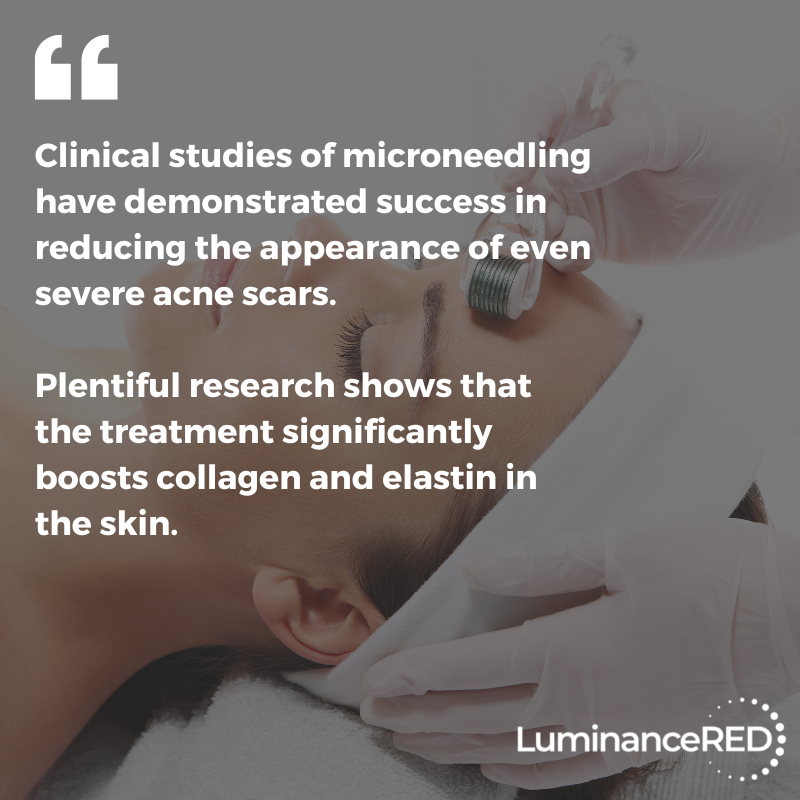 Quote: Microneedling for Acne Scars: What You Need to Know