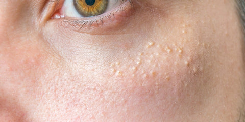 Bumpy skin, White spots, milk spots, dead skin, 