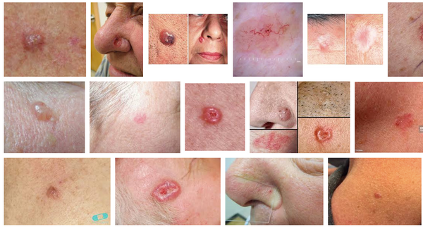 Basal Cell Carcinoma