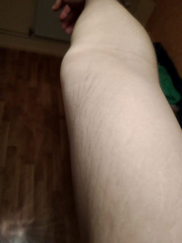 Before After Stretch Mark Treatment