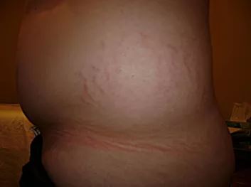 How to Make Stretch Marks Fade: Natural Remedies - ReviewThis