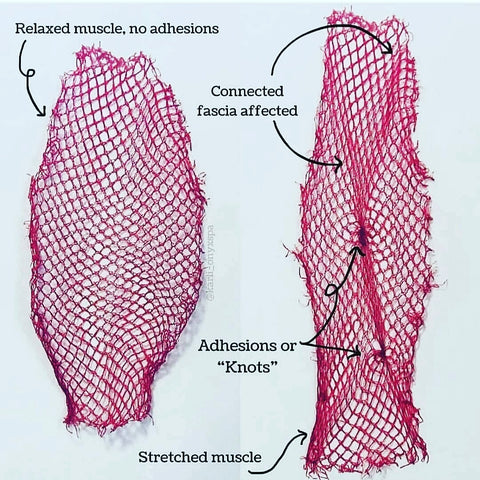 Netting used as an example of adhesions and fascia.