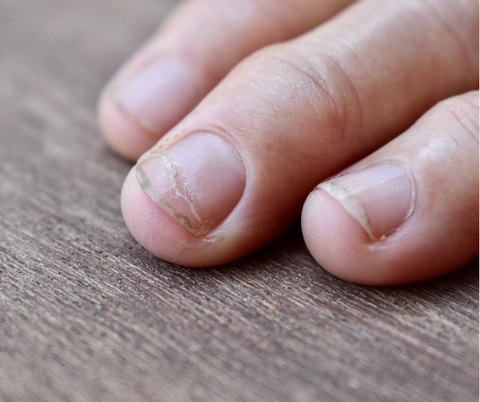 a photo of finger nails that are dry and brittle