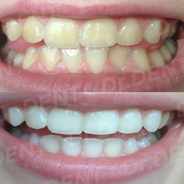 Dr Dent Teeth Whitening Kit Reviews - TeethWalls
