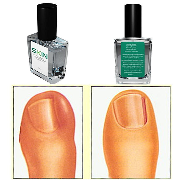 Skinapeel Toe Nail Softener and Ingrowing Toenail Prevention Oil 1