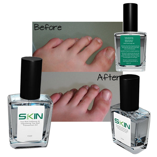 Skinapeel Toe Nail Softener and Ingrowing Toenail Prevention Oil 2