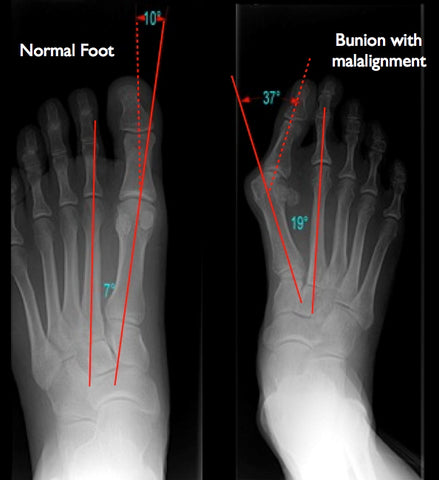 bunion_xray