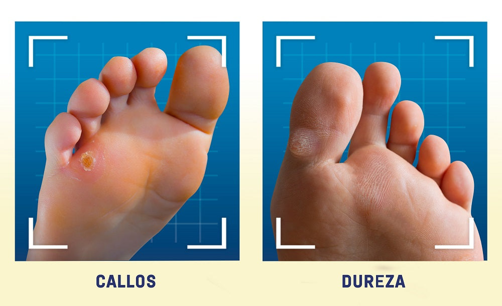 Cómo quitar los callos de los pies – Scholl ES