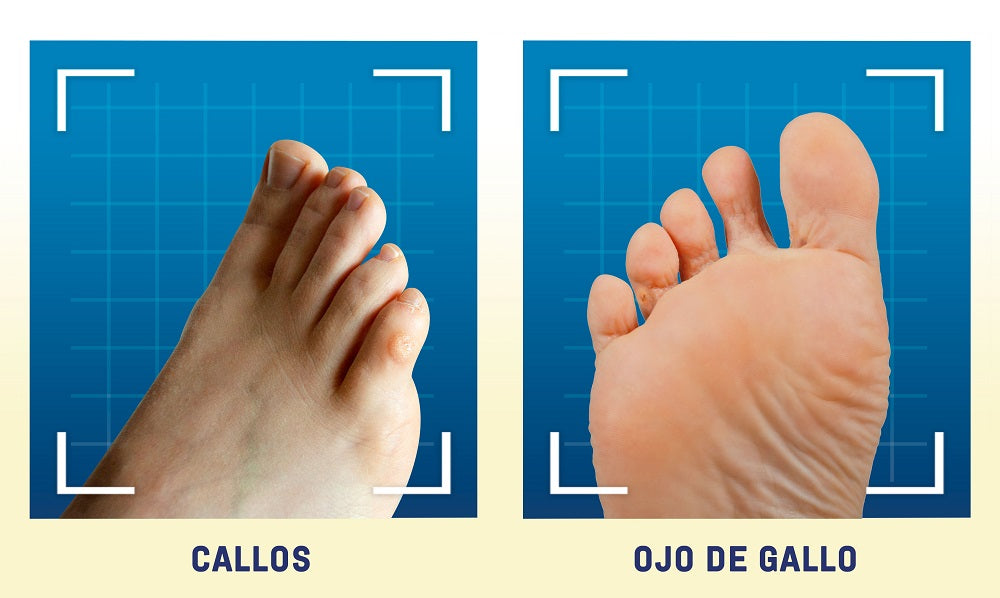 diferencia entre callos y ojos de gallo_Scholl