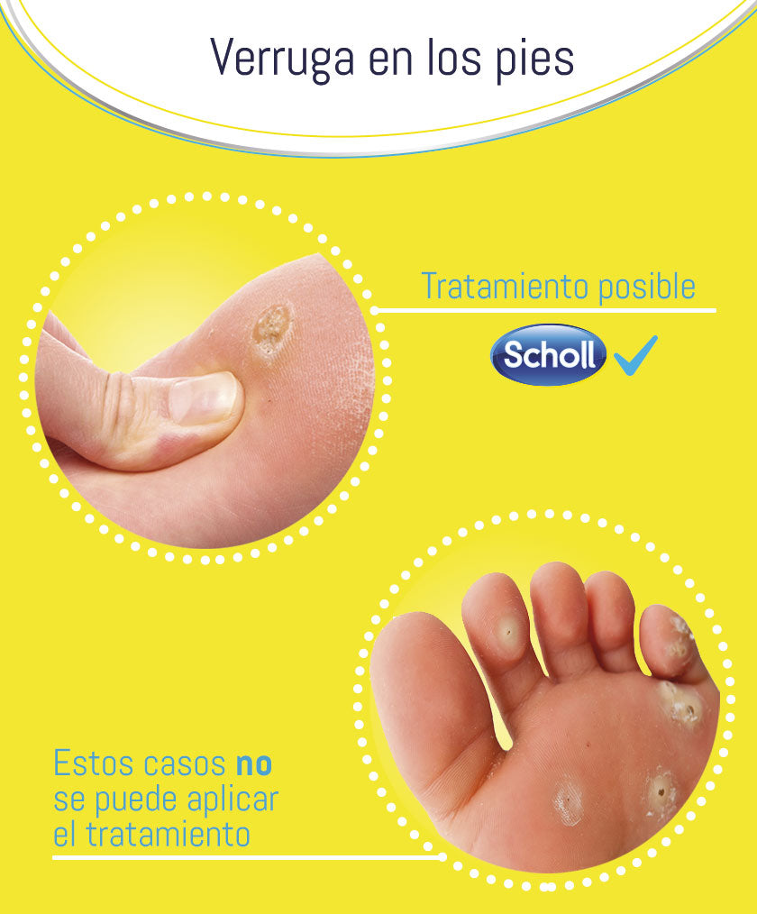 tratamiento Scholl verrugas en los pies