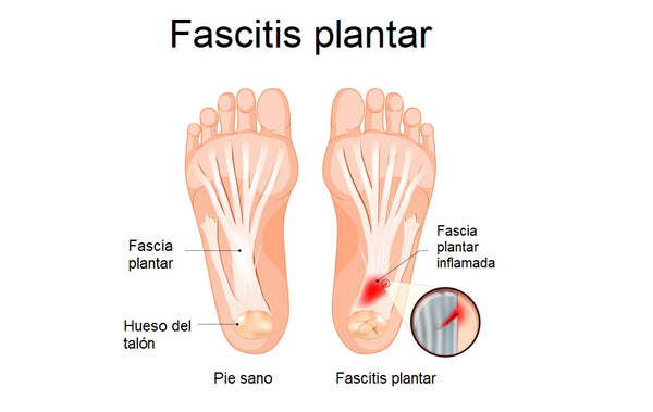 fascitis plantar sintomas