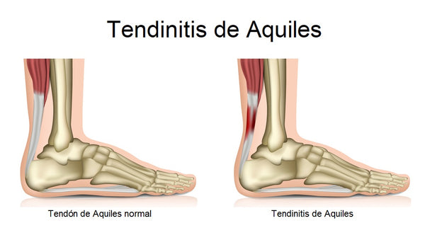 tendinitis de Aquiles sintomas