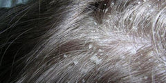 Dandruff