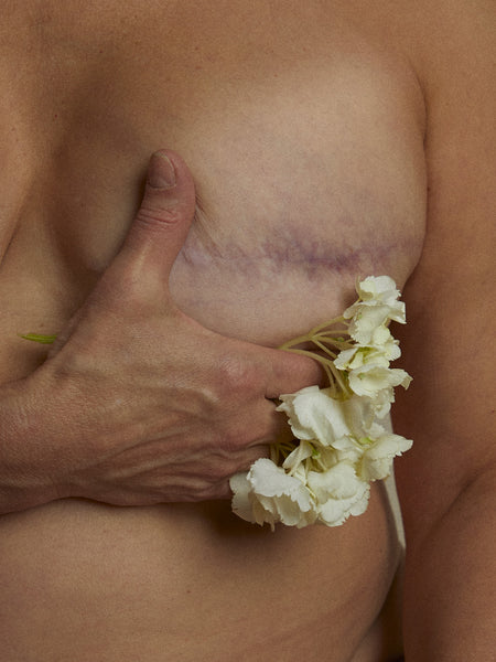 Mastectomy