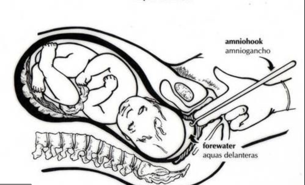 amniotic fluid water breaking pictures