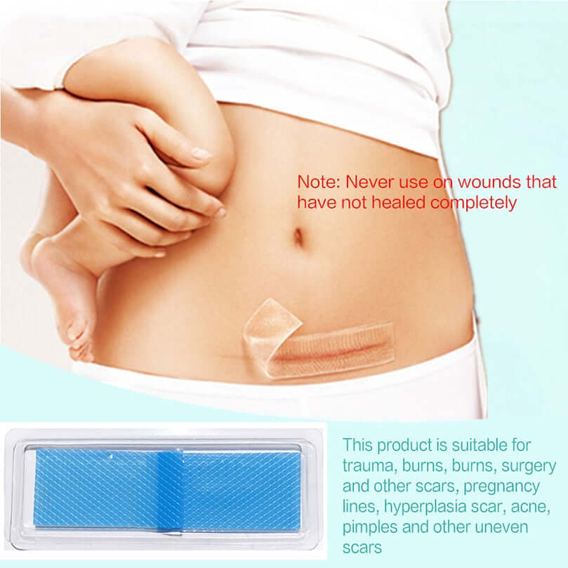 Miracle Stretch Mark + Scar Removal Sheets - Shop For Gamers