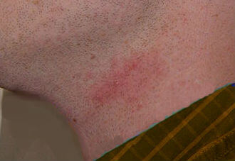 razor burn on neck