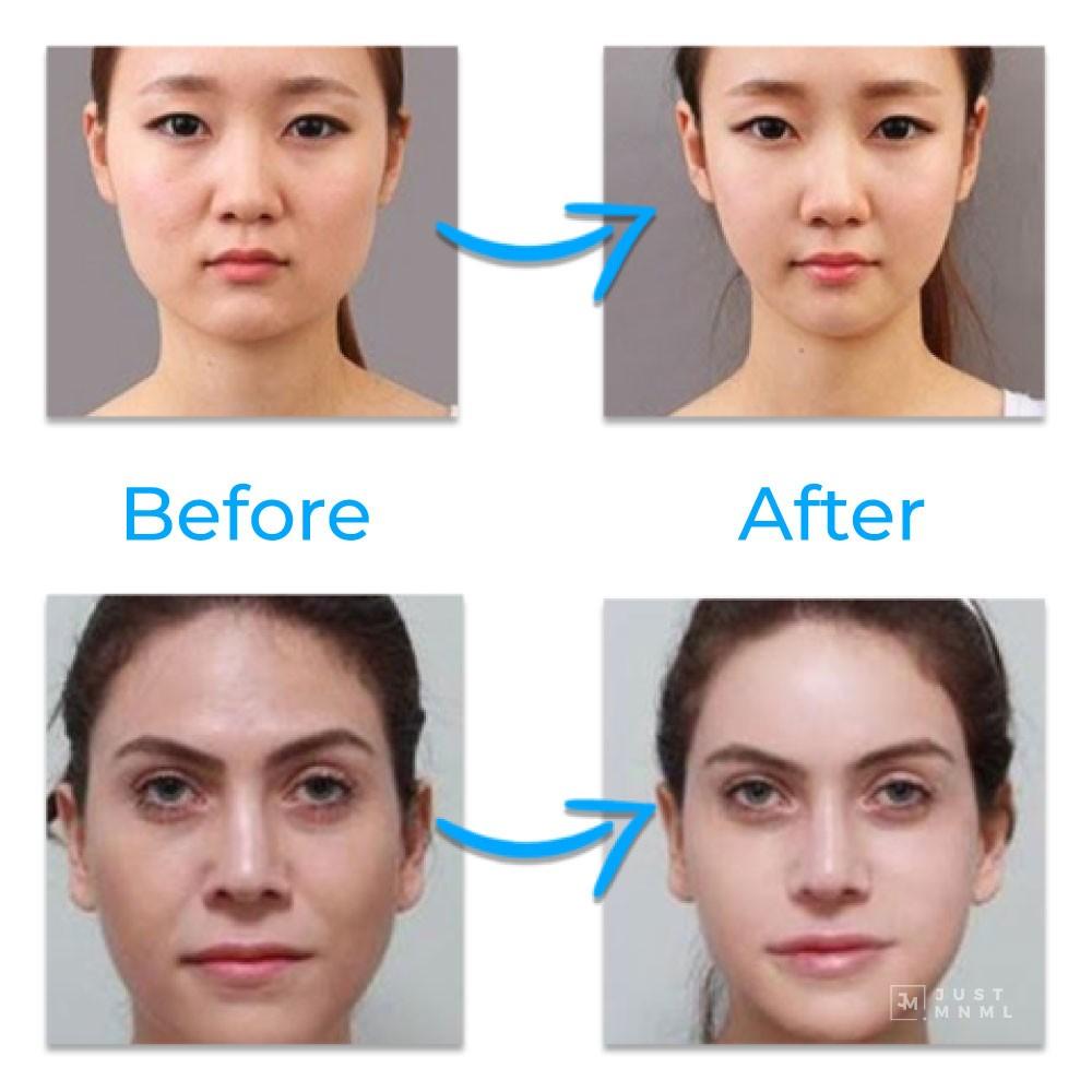 face slimming mask before and after after effects