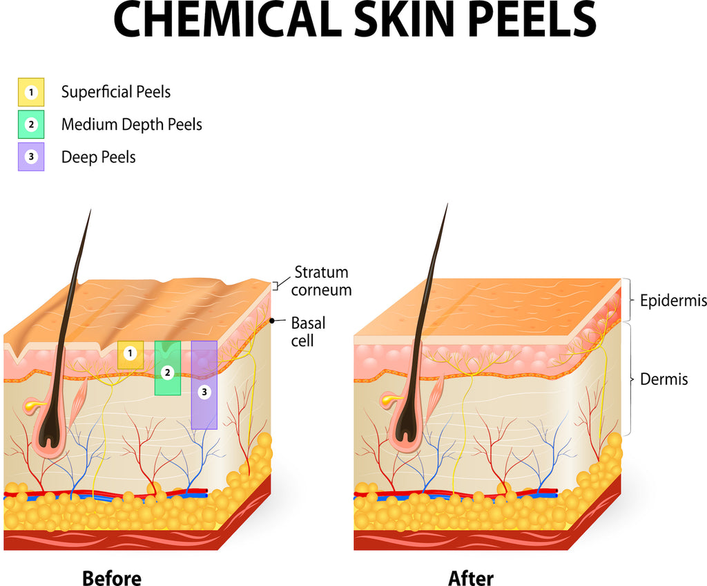 The 4 Best Ways to Care for Your Skin After a Chemical Peel pic