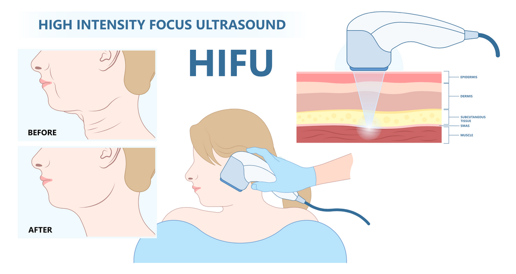 Ultrasound Facelift