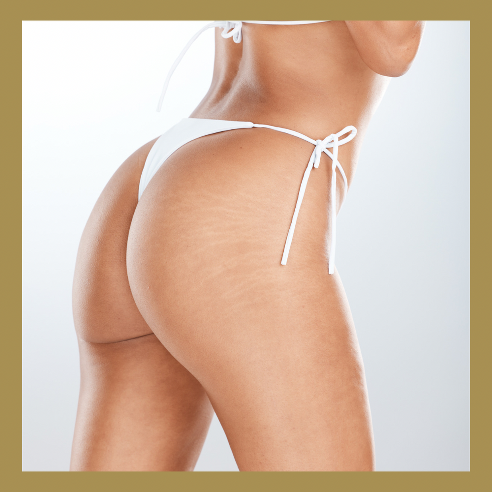 Non-Surgical Butt Lift, BBL