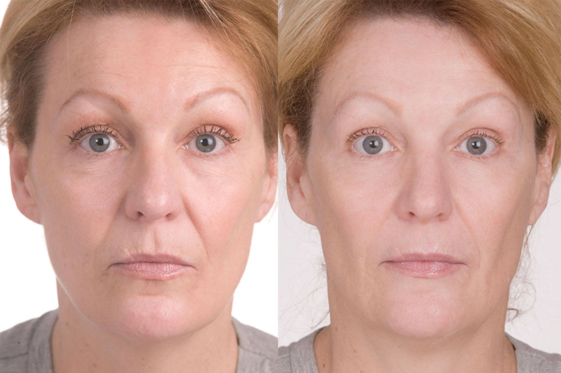 52 year old woman before and after Miracle 10