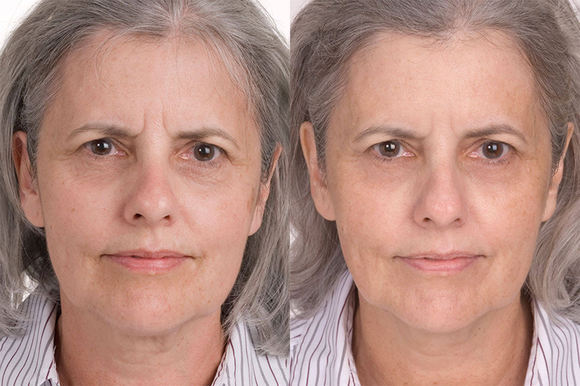 54 year old woman before and after Miracle 10
