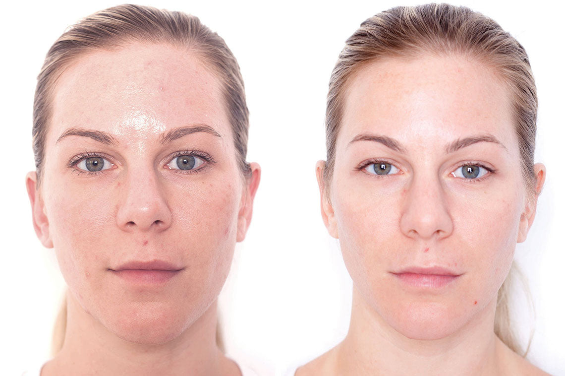 30 year old woman before and after Miracle 10