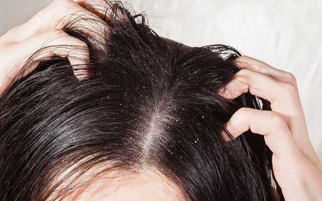 Why Is My Scalp So Itchy  How To Treat It  Laylahair