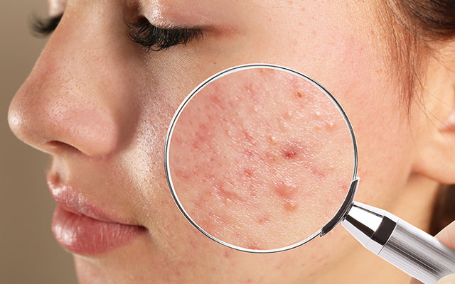 How To Treat Your Blind Pimples With Ayurveda? – Vedix