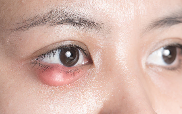 3 Steps To Get Rid Of A Stye On Your Eyelid - Baptist Eye Surgeons
