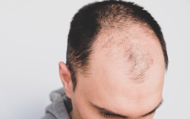Male pattern baldness Know its causes and treatment