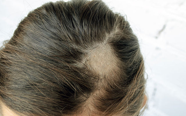 Alopecia Barbae Causes Symptoms And Treatment  Boldskycom