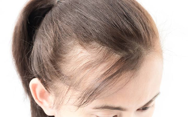 Hair loss What is femalepattern baldness  BBC News