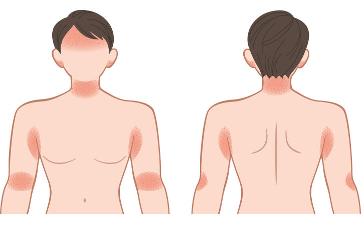 MyMed.com on X: Intertrigo-inflammatory skin rash that occurs due to  chafing. Occurs underneath breasts, armpits, groin, abdomen, inner thighs,  crease of neck, in between toes, fingers, between buttocks & genitals.  Symptoms: Itchy