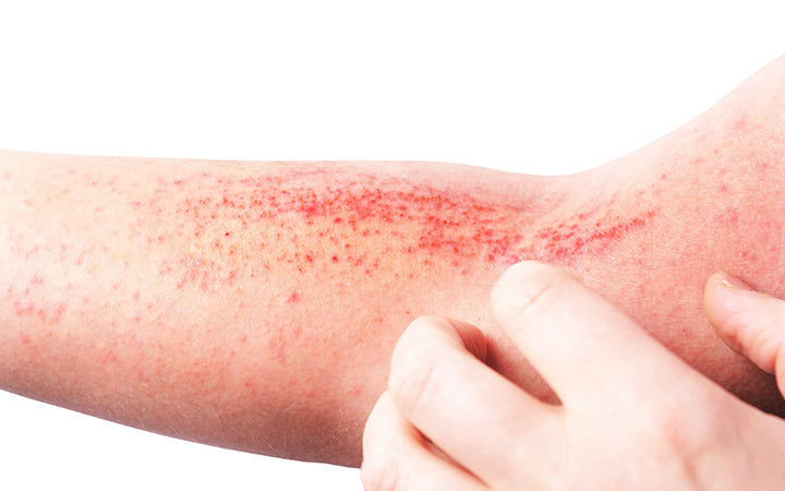 atopic dermatitis on human skin