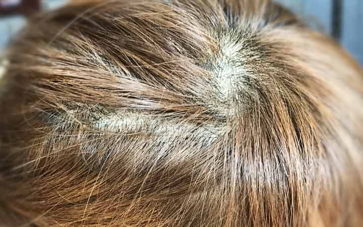 Hair Pulling Disorder, Trichotillomania