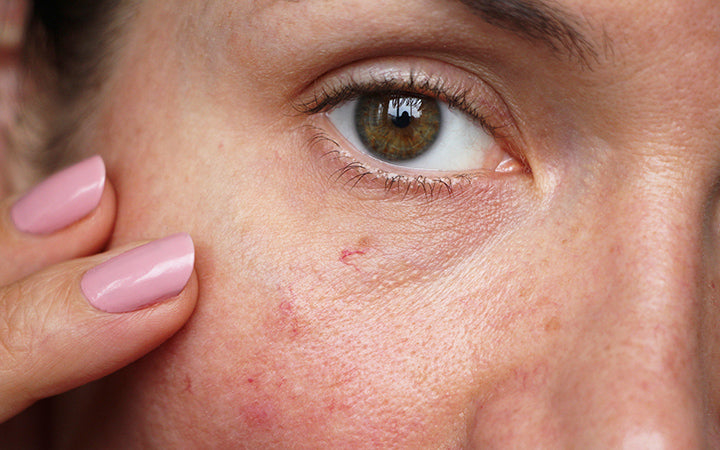 capillaries on the skin of the face