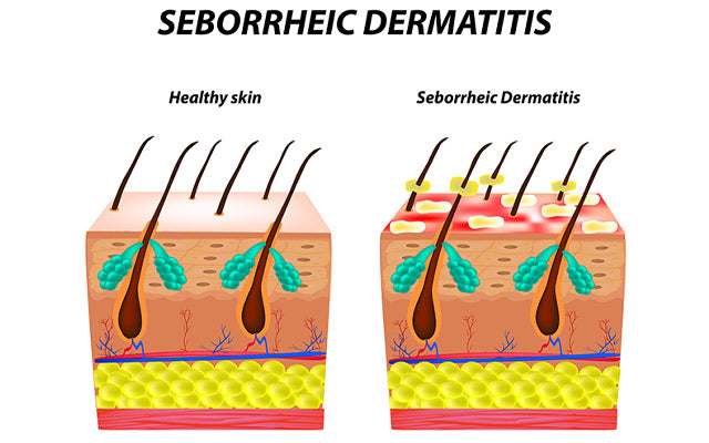 Seborrheic Dermatitis On Scalp: Symptoms, Causes, Treatments – Vedix