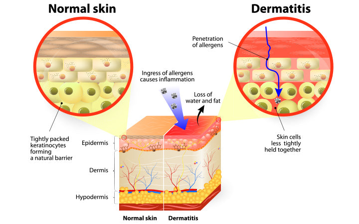 eczema vector diagram