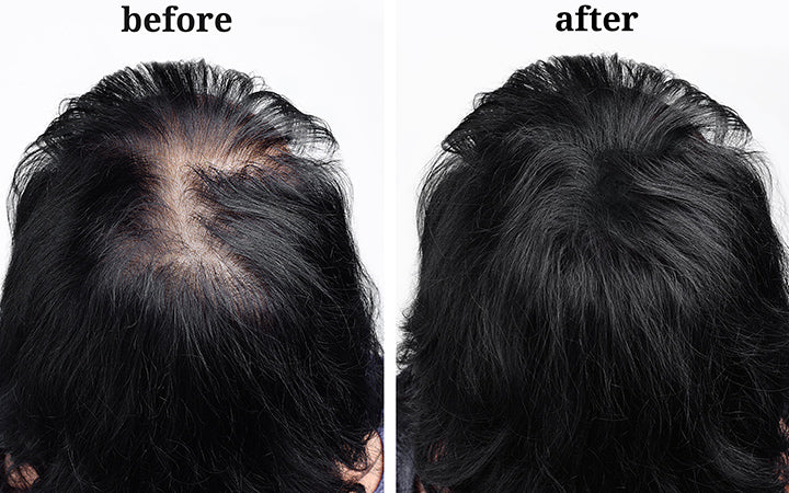 How to stop balding naturally increase